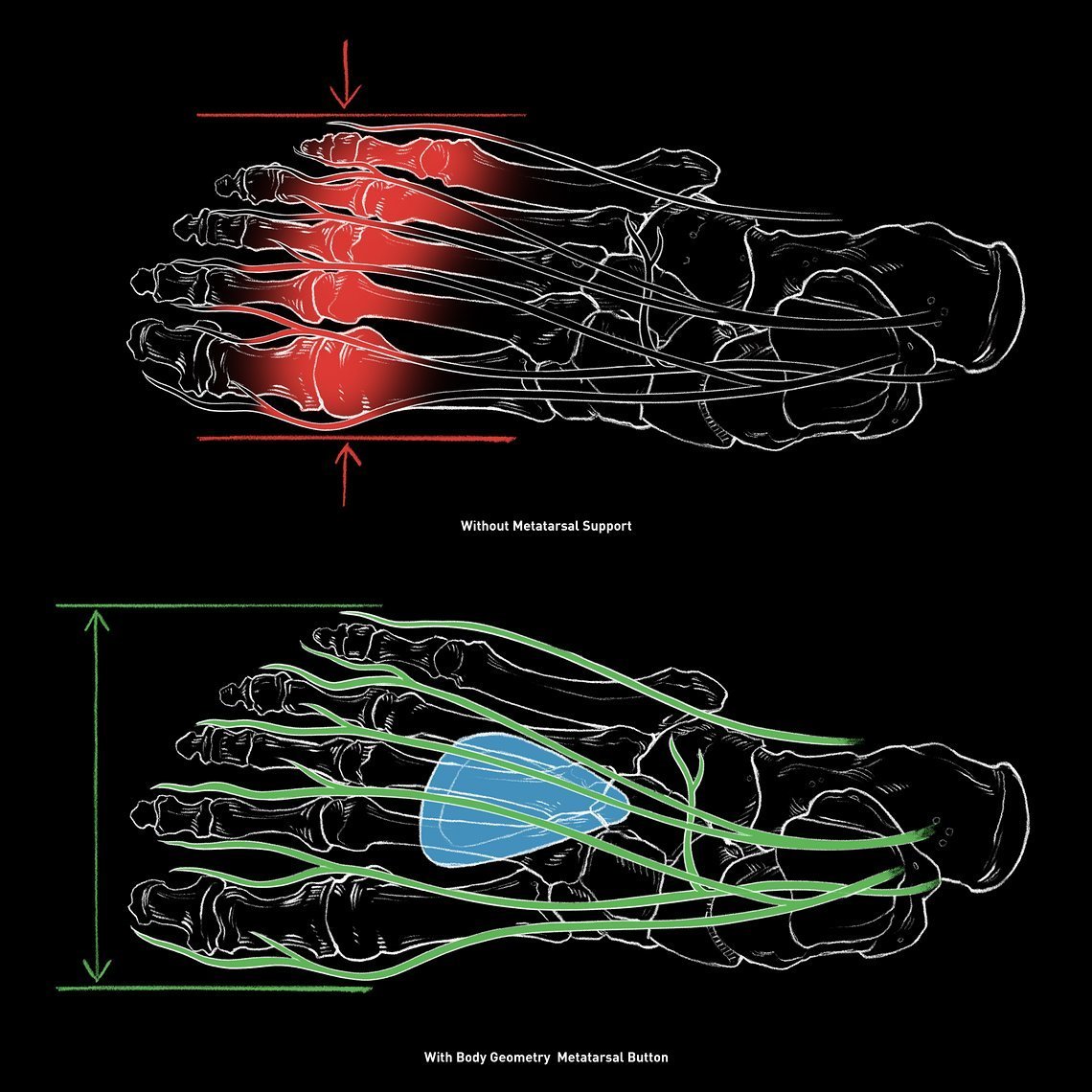 Der „Metatarsal Button“ in der Sohle hebt die Knochen im Vorfuß