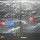 Tiefe Venenthrombose im Ultraschallbild